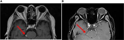 Case Report: Reversible Neurotoxicity and a Clinical Response Induced by BCMA-Directed Chimeric Antigen Receptor T Cells Against Multiple Myeloma With Central Nervous System Involvement